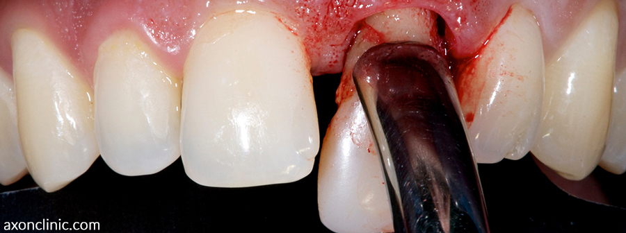 تاثیر مصرف شیشه بر سلامت دندان