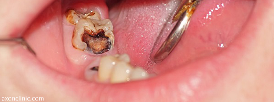 تأثیر مصرف مواد مخدر بر سلامت دندان